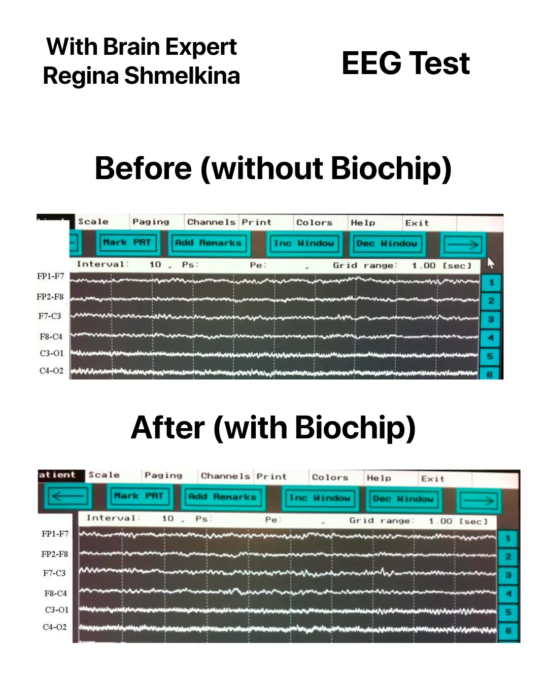 EEG recordings before (without BioCard) and after (with BioCard) — six EEG channels showing changes in alpha-rhythm activity
