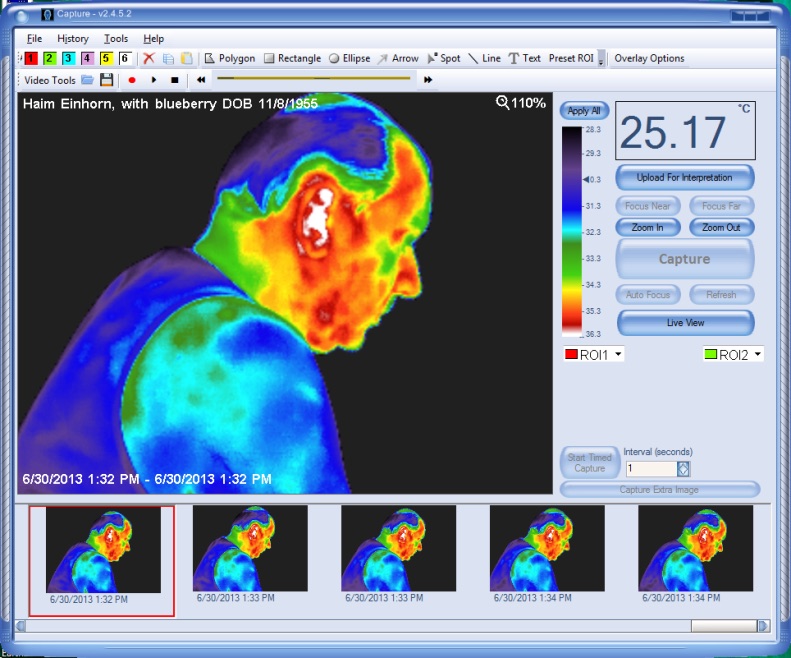 FLIR thermal image after 45 minutes of phone use without BioChip — bright red and white hot zone clearly visible at the right ear